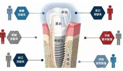 以色列牙种植体排名公布,哪一款性比价比较高?