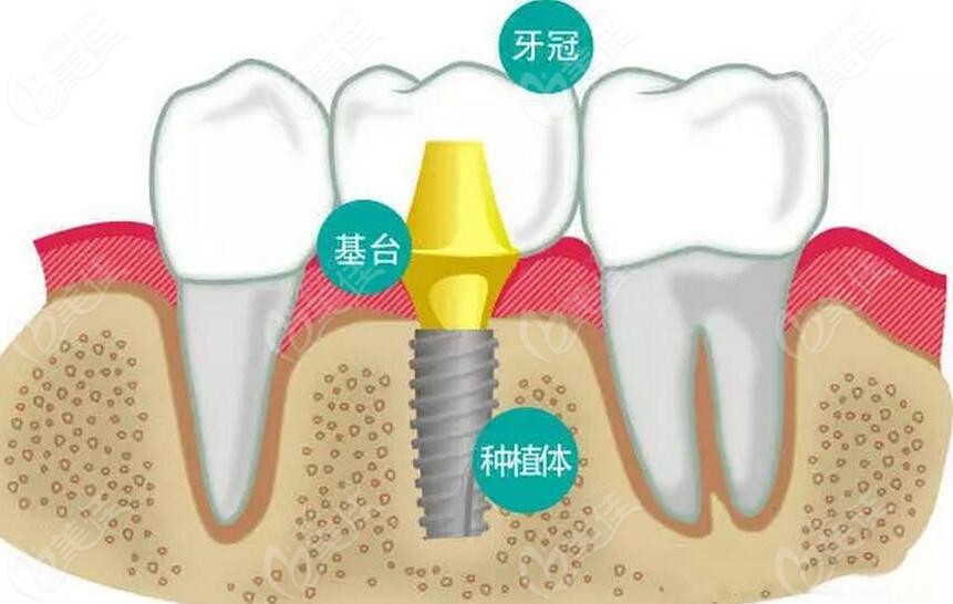 潮州极至口腔价目表:正规医院种植牙|矫正|全瓷牙收费不贵 - 口腔资讯