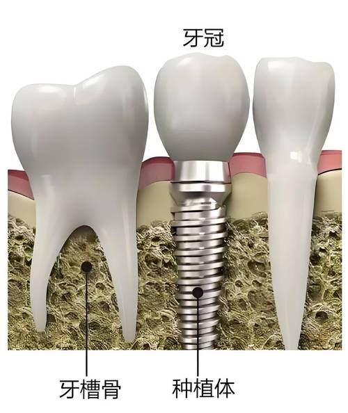 邢台宏皓口腔为您解读:什么是种植牙?什么是镶牙?两者有什么区别?