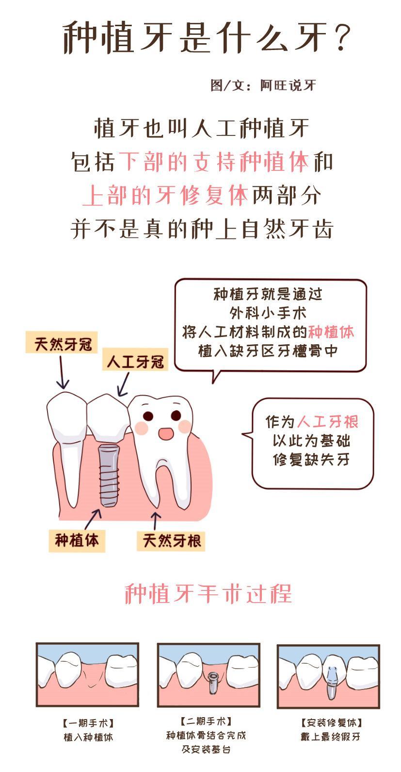 「口腔漫画」种植牙是什么牙?