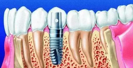 种植牙的优势和趋势