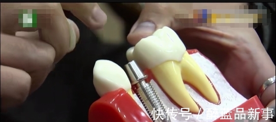 种植牙水很深,花了25000元却是三无产品,去口腔医院要注意这个
