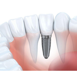 全口种植牙 重获一口健康自信的微笑