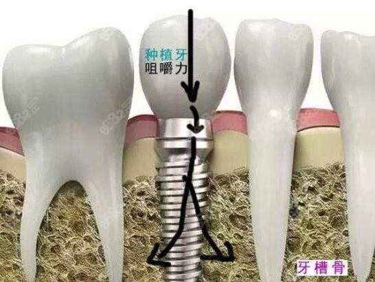 韩国登腾与瑞士ITI种植体 风险与后遗症全面解析