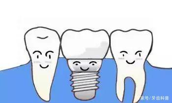 种植牙手术后注意事项 保护种植体,维护口腔健康