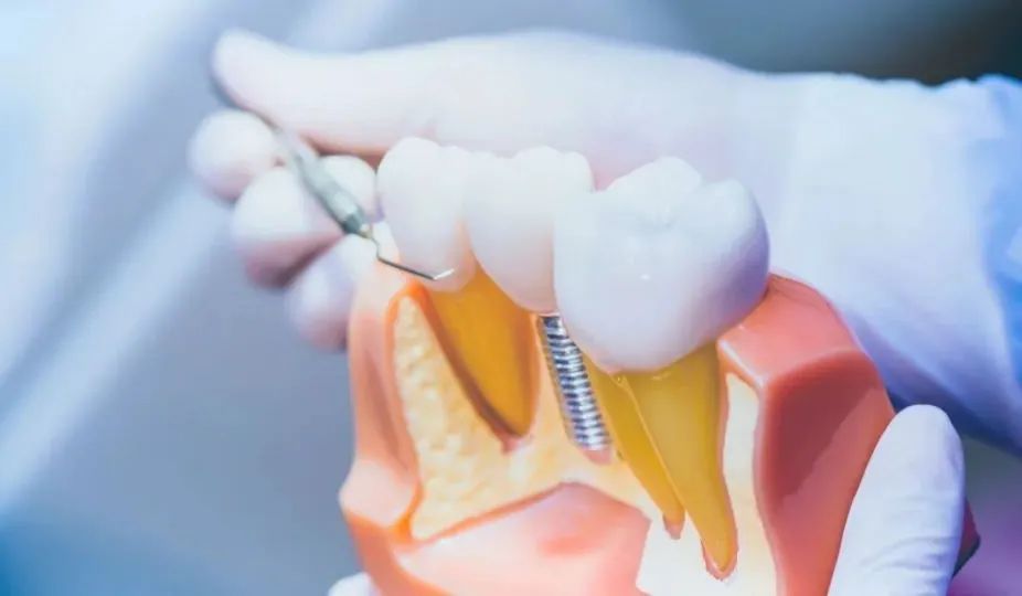 种植牙集采 如何破解监管难点