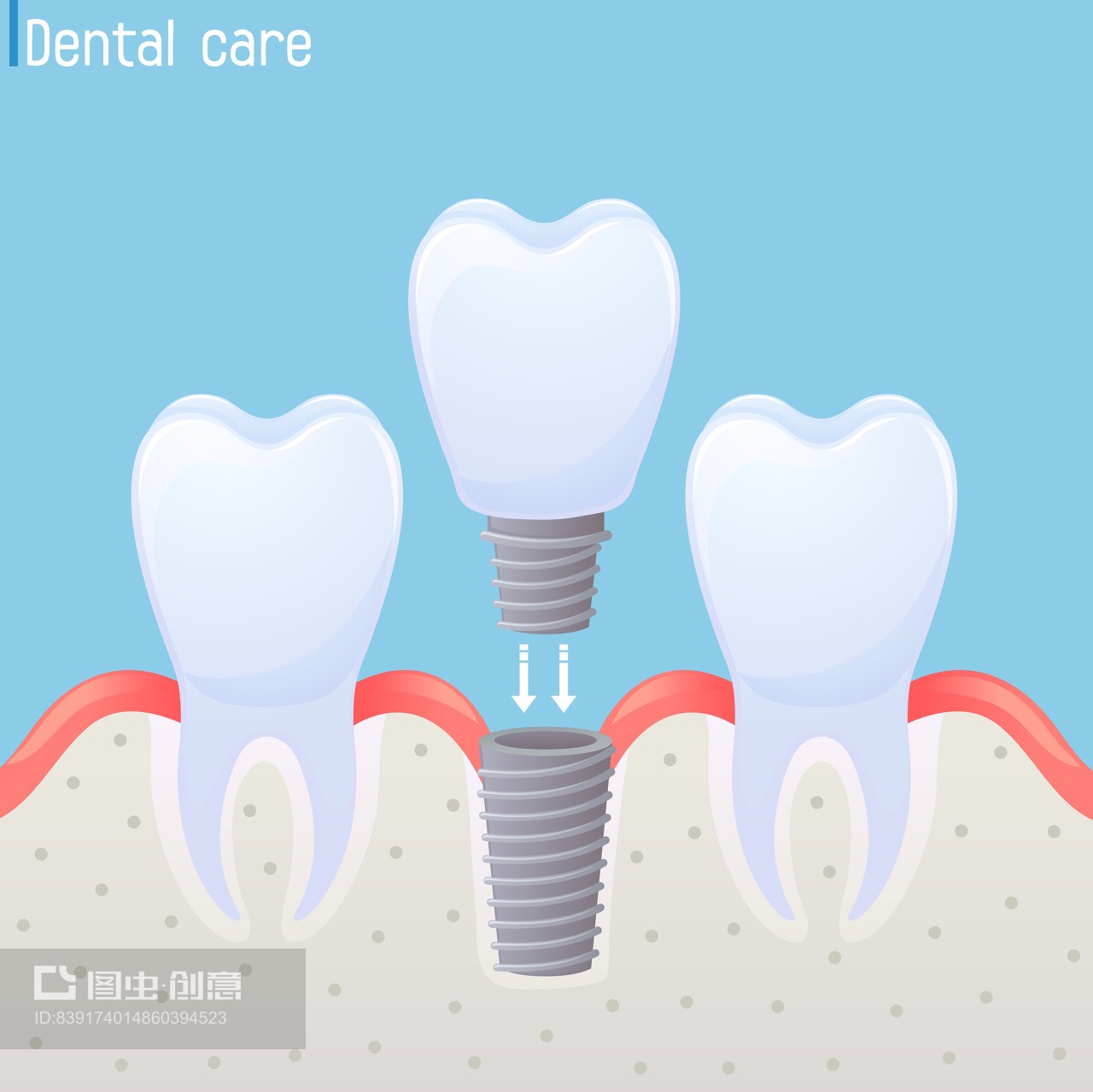 种植牙图解 - Illustration of Dental Implant