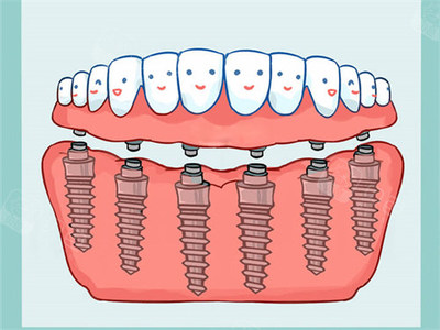 2024年种植牙市场调查 单颗、半口、全口价格全解析