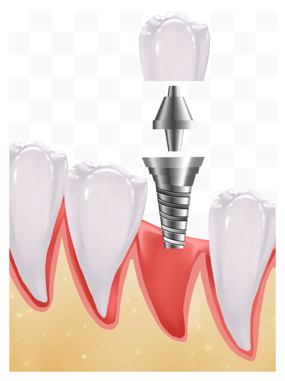 3D技术与种植牙 精准修复,重现自然笑容