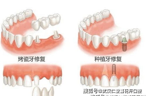 缺牙应及时止损,种植牙与烤瓷牙如何选择?