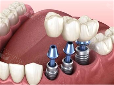 韩国奥齿泰与美国皓圣种植牙 区别对比与选择建议