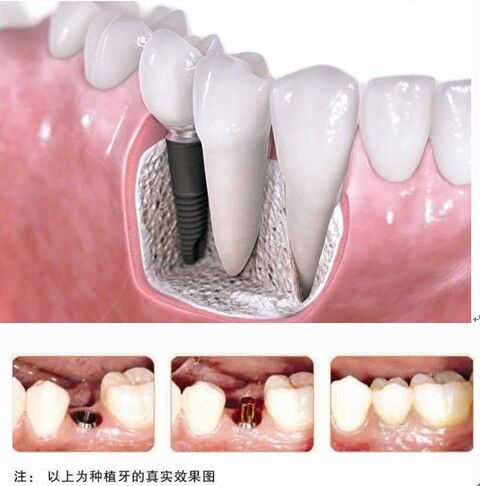 种植牙的使用寿命 长期可靠的缺牙解决方案